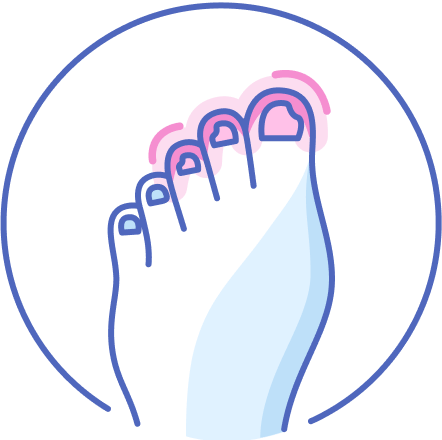 Wrastające paznokcie